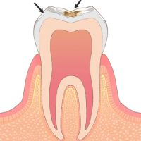 むし歯の初期症状C1