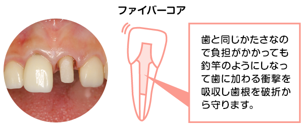 ファイバーコア説明画像