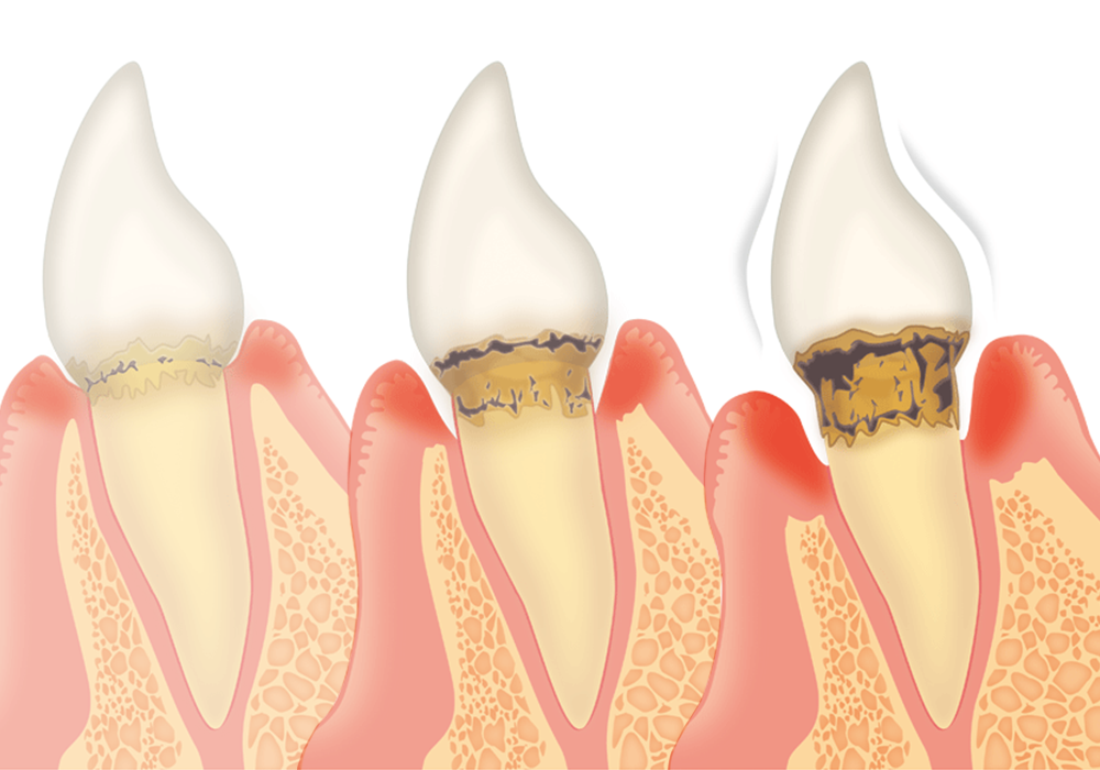 歯周病の過程