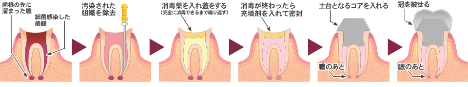 根管治療の過程