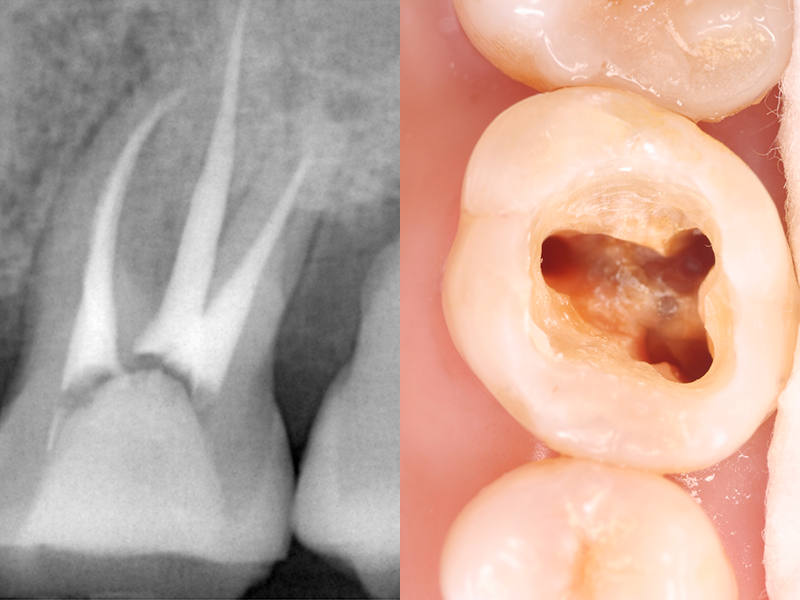 根管治療している歯の様子