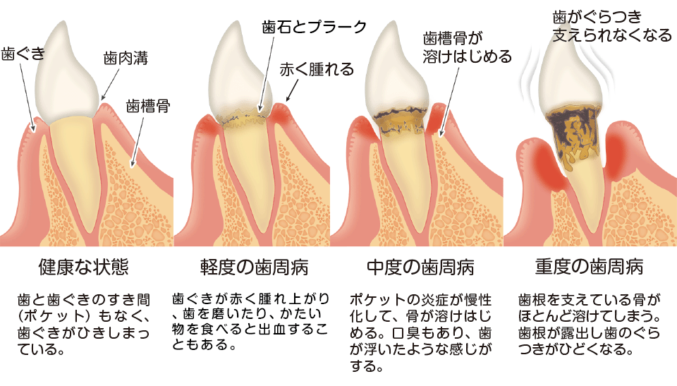 歯周病の過程